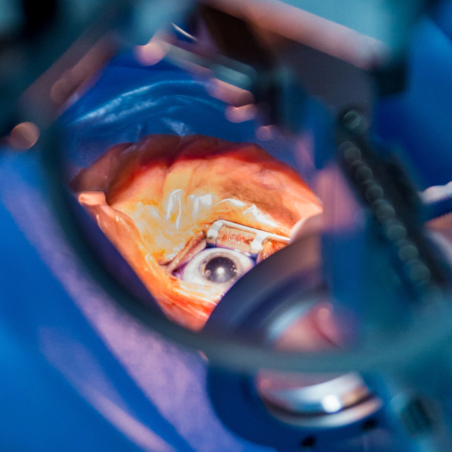 Retinal Detachment Treatment