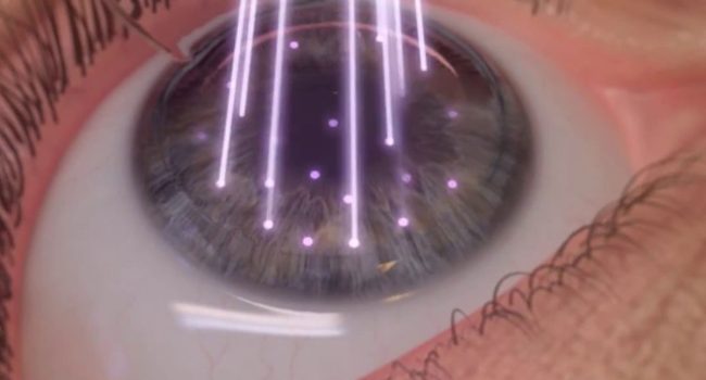 cirugia.refractiva