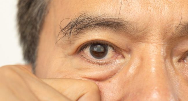 motibindu-surgery-for-safe-clear-vision-and-faster-recovery-today